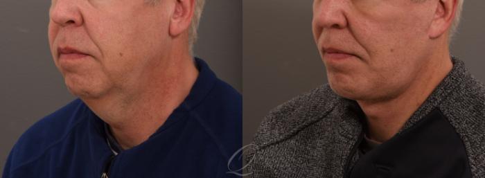 Chin Augmentation Case 1001635 Before & After Left Oblique | Serving Rochester, Syracuse & Buffalo, NY | Quatela Center for Plastic Surgery