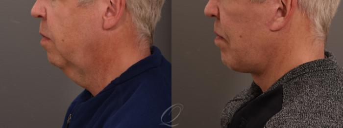 Chin Augmentation Case 1001635 Before & After Left Side | Serving Rochester, Syracuse & Buffalo, NY | Quatela Center for Plastic Surgery