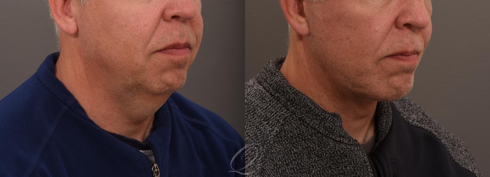 Chin Augmentation Case 1001635 Before & After Right Oblique | Serving Rochester, Syracuse & Buffalo, NY | Quatela Center for Plastic Surgery