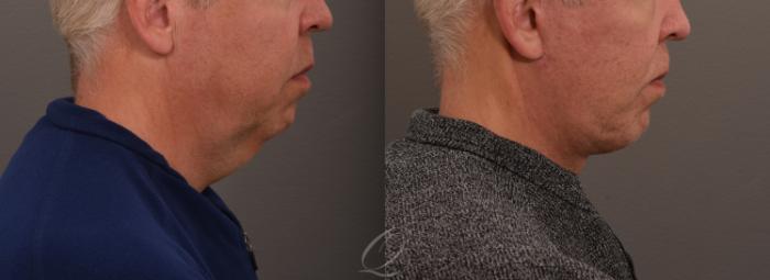 Chin Augmentation Case 1001635 Before & After Right Side | Serving Rochester, Syracuse & Buffalo, NY | Quatela Center for Plastic Surgery