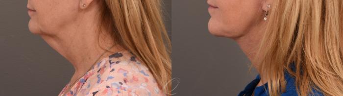 Facelift Case 1001637 Before & After Left Side | Serving Rochester, Syracuse & Buffalo, NY | Quatela Center for Plastic Surgery