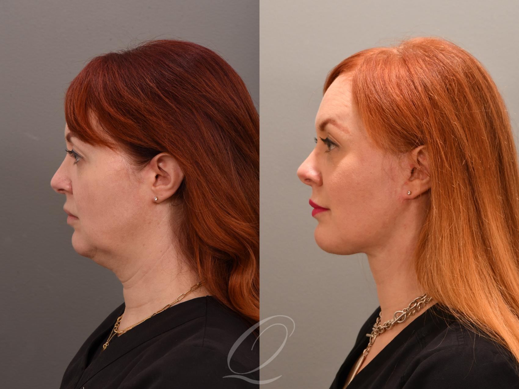 Facelift Case 1001638 Before & After Left Side | Serving Rochester, Syracuse & Buffalo, NY | Quatela Center for Plastic Surgery