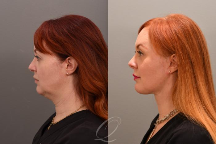 Facelift Case 1001638 Before & After Right Side | Serving Rochester, Syracuse & Buffalo, NY | Quatela Center for Plastic Surgery