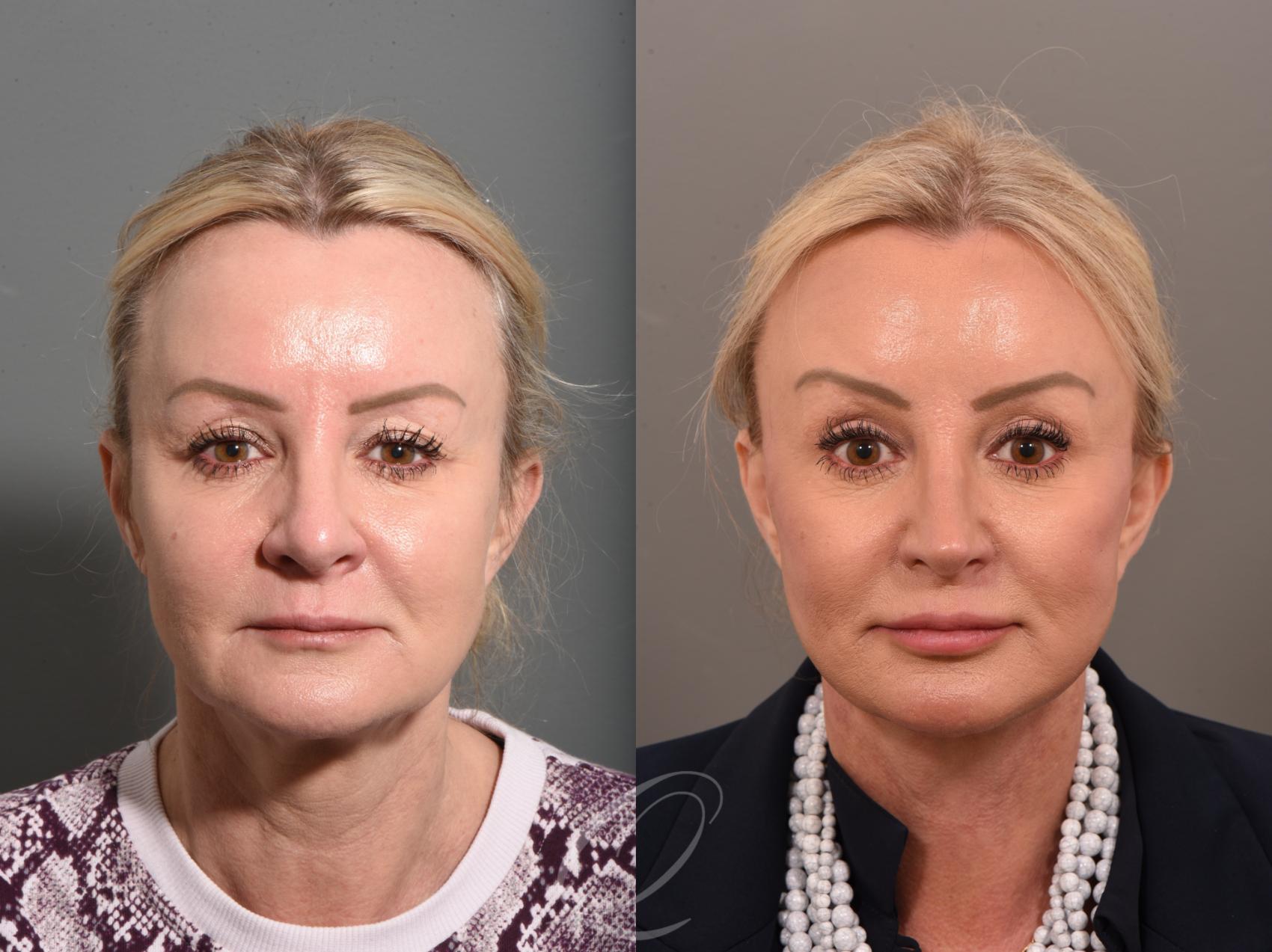 Facelift Case 1001640 Before & After Front | Serving Rochester, Syracuse & Buffalo, NY | Quatela Center for Plastic Surgery
