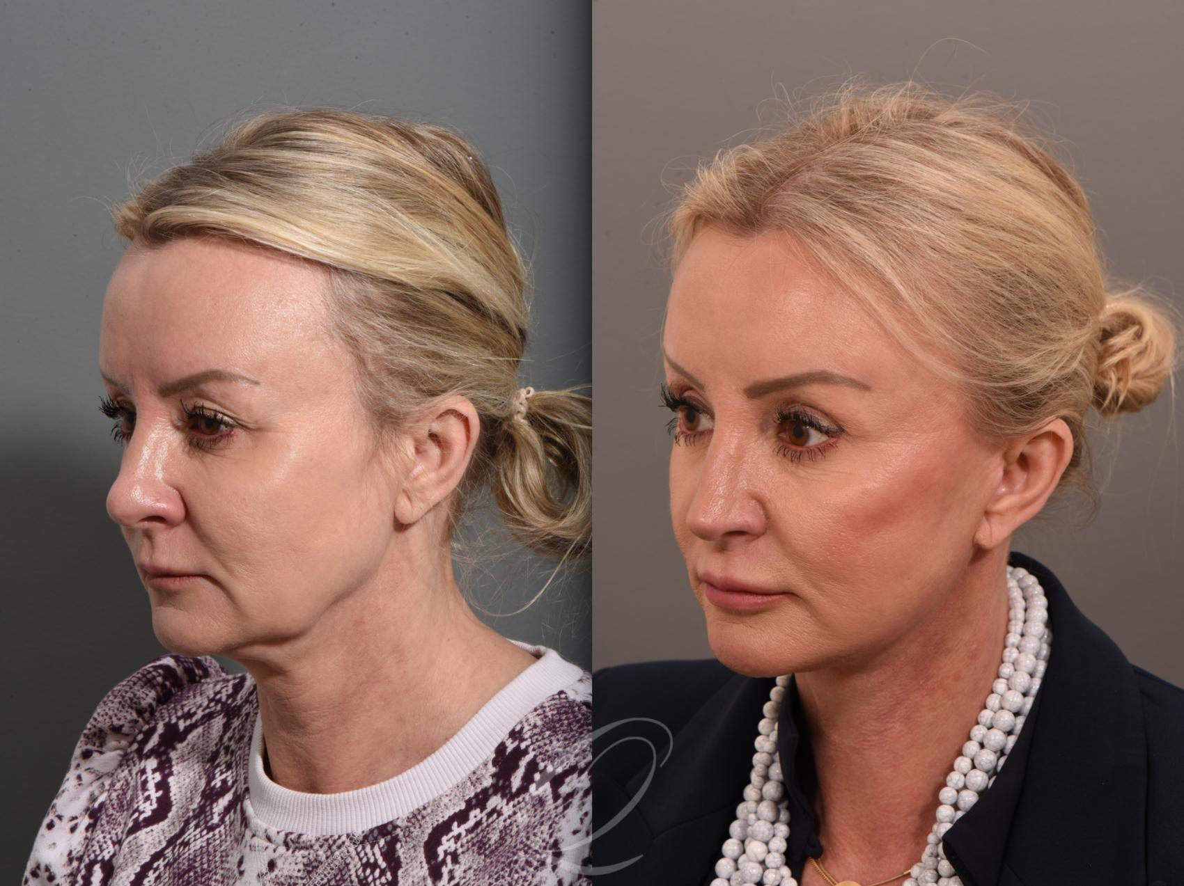 Facelift Case 1001640 Before & After Left Oblique | Serving Rochester, Syracuse & Buffalo, NY | Quatela Center for Plastic Surgery