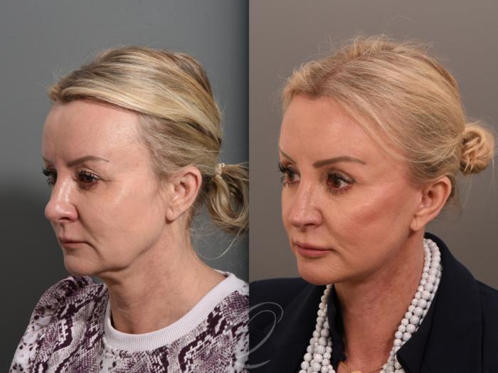 Facelift Case 1001640 Before & After Left Oblique | Serving Rochester, Syracuse & Buffalo, NY | Quatela Center for Plastic Surgery