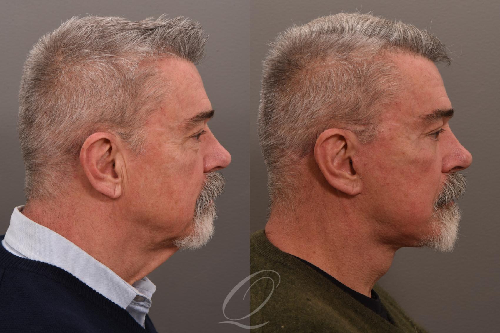 Facelift Case 1001645 Before & After Right Side | Serving Rochester, Syracuse & Buffalo, NY | Quatela Center for Plastic Surgery