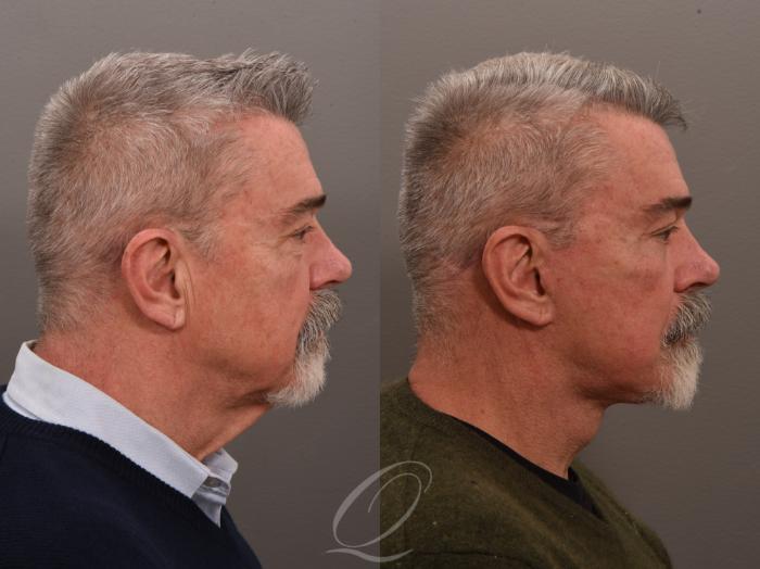 Facelift Case 1001645 Before & After Right Side | Serving Rochester, Syracuse & Buffalo, NY | Quatela Center for Plastic Surgery