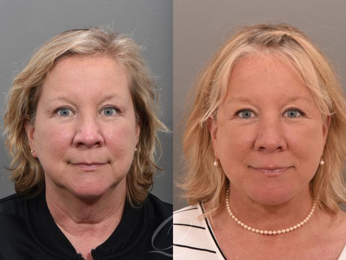 Facelift Case 1001646 Before & After Front | Serving Rochester, Syracuse & Buffalo, NY | Quatela Center for Plastic Surgery