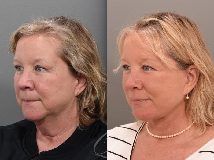 Facelift Case 1001646 Before & After Left Oblique | Serving Rochester, Syracuse & Buffalo, NY | Quatela Center for Plastic Surgery