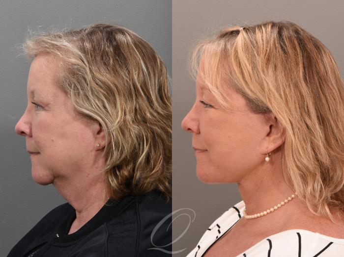 Facelift Case 1001646 Before & After Left Side | Serving Rochester, Syracuse & Buffalo, NY | Quatela Center for Plastic Surgery