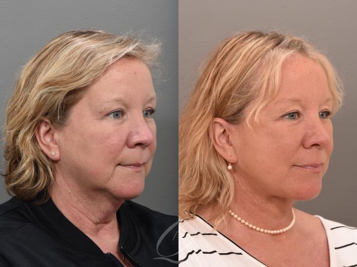 Facelift Case 1001646 Before & After Right Oblique | Serving Rochester, Syracuse & Buffalo, NY | Quatela Center for Plastic Surgery