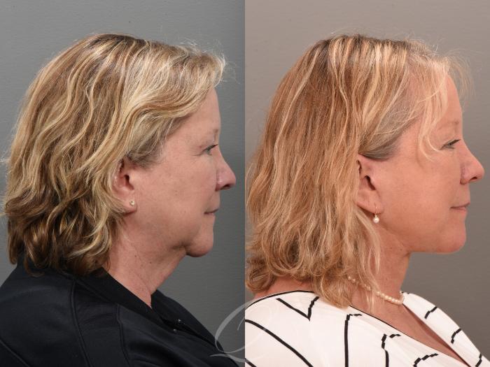 Facelift Case 1001646 Before & After Right Side | Serving Rochester, Syracuse & Buffalo, NY | Quatela Center for Plastic Surgery