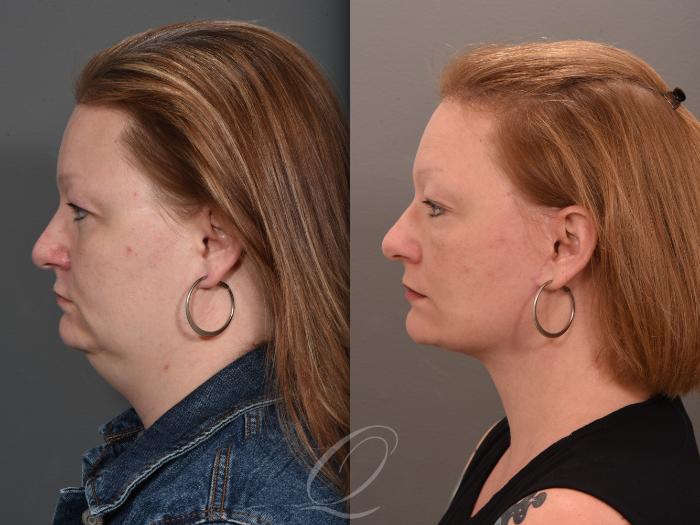 Facelift Case 1001647 Before & After Left Side | Serving Rochester, Syracuse & Buffalo, NY | Quatela Center for Plastic Surgery
