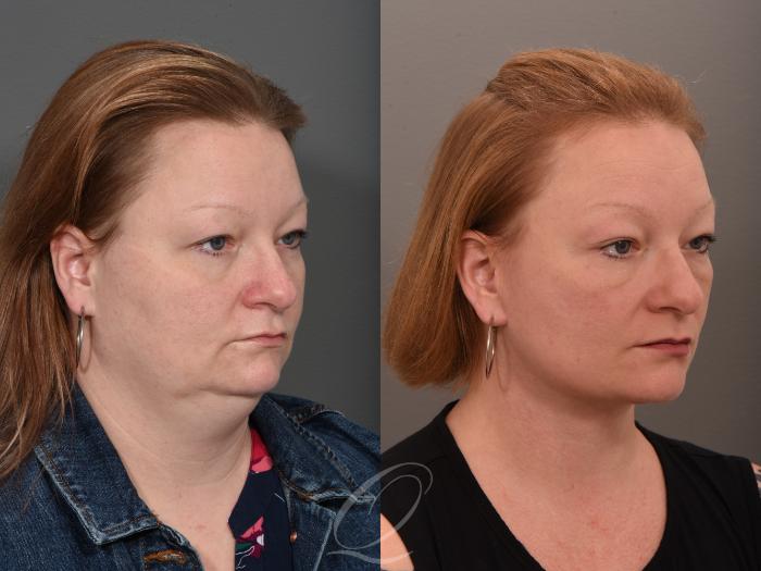 Facelift Case 1001647 Before & After Right Oblique | Serving Rochester, Syracuse & Buffalo, NY | Quatela Center for Plastic Surgery