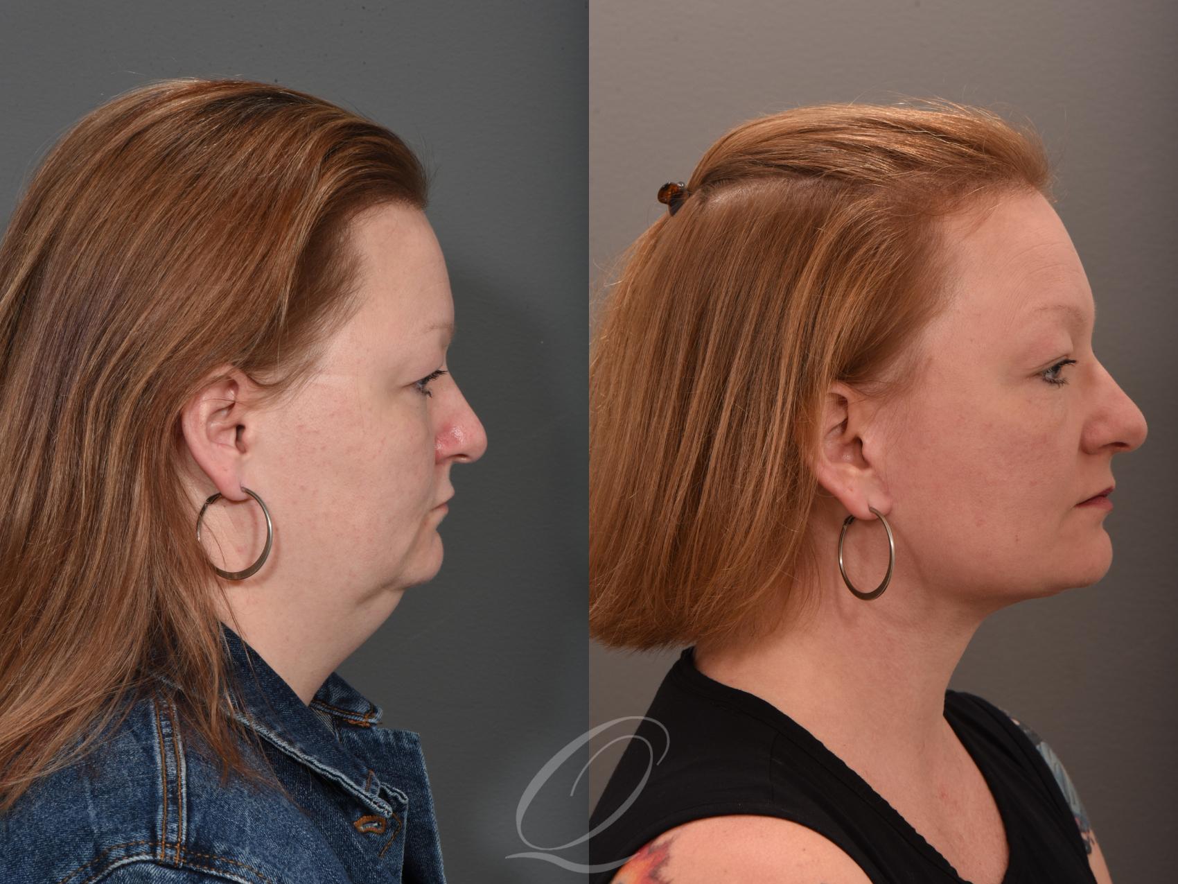 Facelift Case 1001647 Before & After Right Side | Serving Rochester, Syracuse & Buffalo, NY | Quatela Center for Plastic Surgery