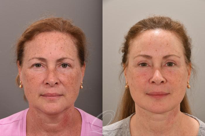 Brow Lift Case 1001664 Before & After Front | Serving Rochester, Syracuse & Buffalo, NY | Quatela Center for Plastic Surgery