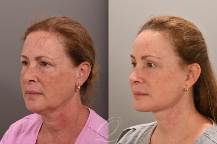 Eyelid Lift Case 1001664 Before & After Left Oblique | Serving Rochester, Syracuse & Buffalo, NY | Quatela Center for Plastic Surgery
