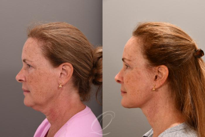 Facelift Case 1001664 Before & After Left Side | Serving Rochester, Syracuse & Buffalo, NY | Quatela Center for Plastic Surgery