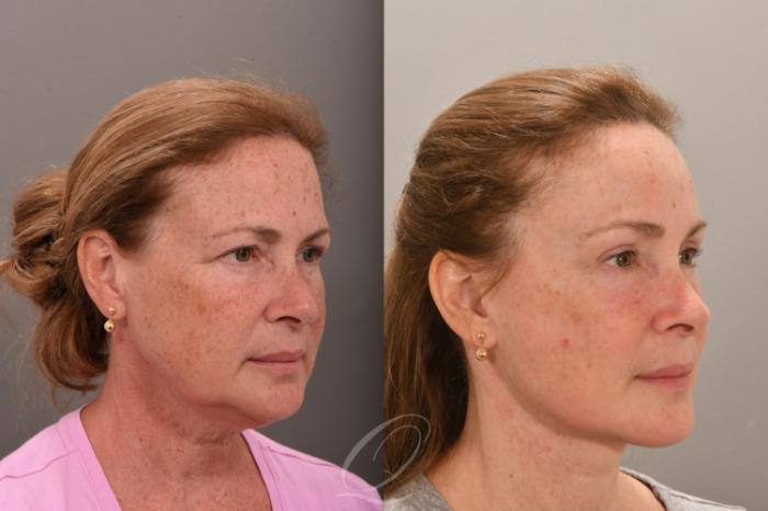 Facelift Case 1001664 Before & After Right Oblique | Serving Rochester, Syracuse & Buffalo, NY | Quatela Center for Plastic Surgery