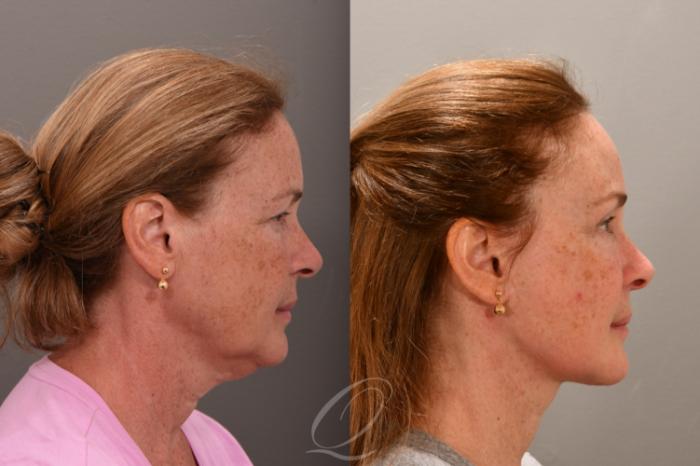 Fat Injections Case 1001664 Before & After Right Side | Serving Rochester, Syracuse & Buffalo, NY | Quatela Center for Plastic Surgery