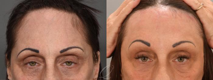 Brow Lift Case 1001707 Before & After Close Up | Serving Rochester, Syracuse & Buffalo, NY | Quatela Center for Plastic Surgery
