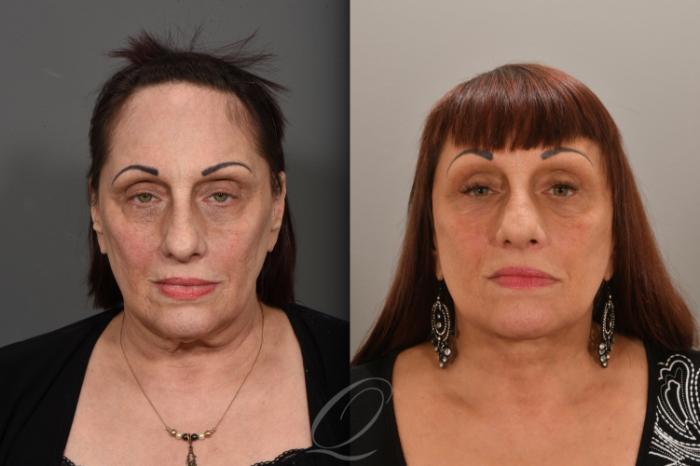 Facelift Case 1001707 Before & After Front | Serving Rochester, Syracuse & Buffalo, NY | Quatela Center for Plastic Surgery
