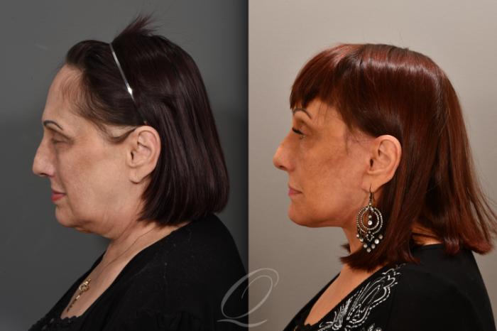 Facelift Case 1001707 Before & After Left Side | Serving Rochester, Syracuse & Buffalo, NY | Quatela Center for Plastic Surgery