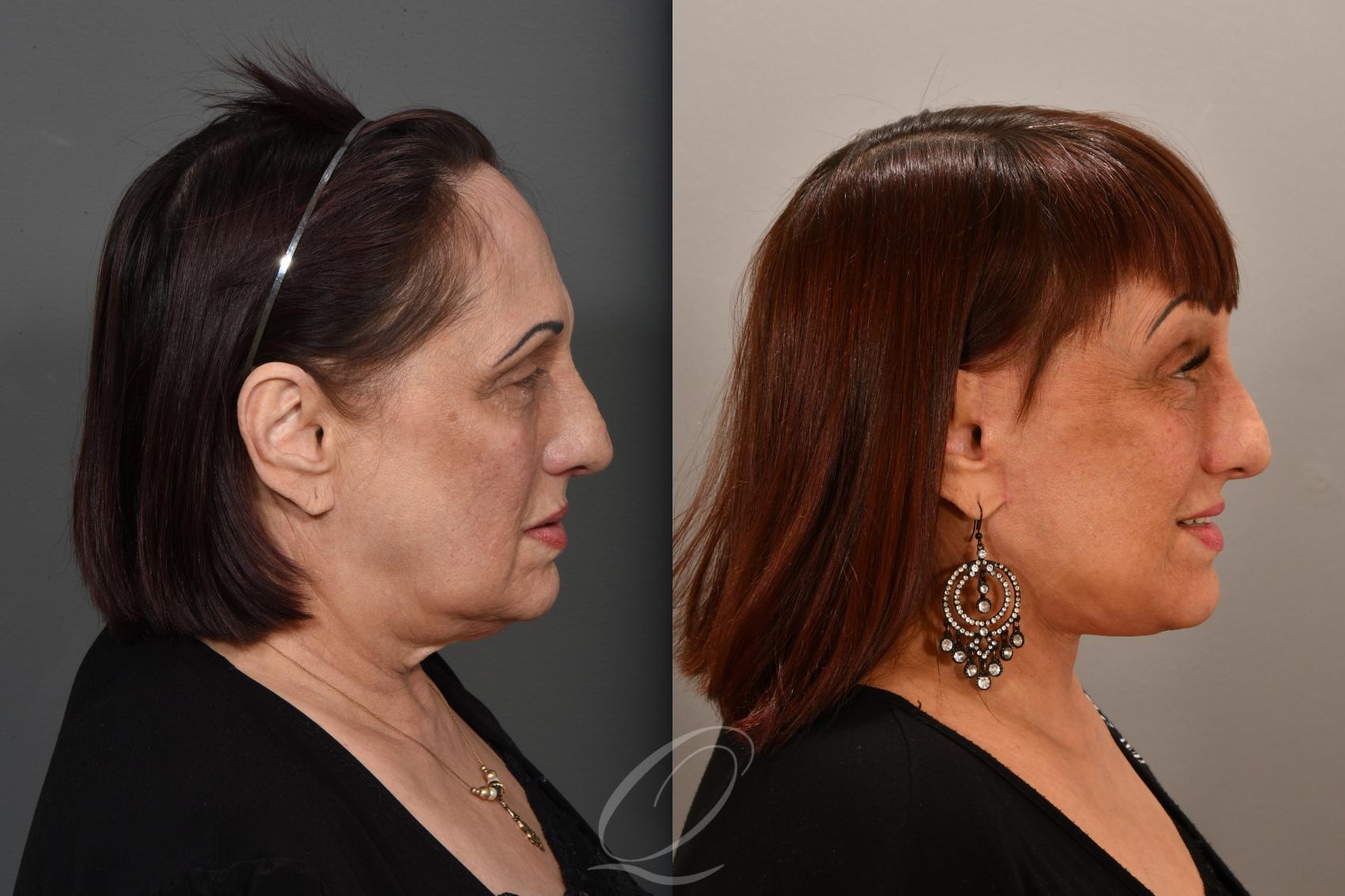 Facelift Case 1001707 Before & After Right Side | Serving Rochester, Syracuse & Buffalo, NY | Quatela Center for Plastic Surgery