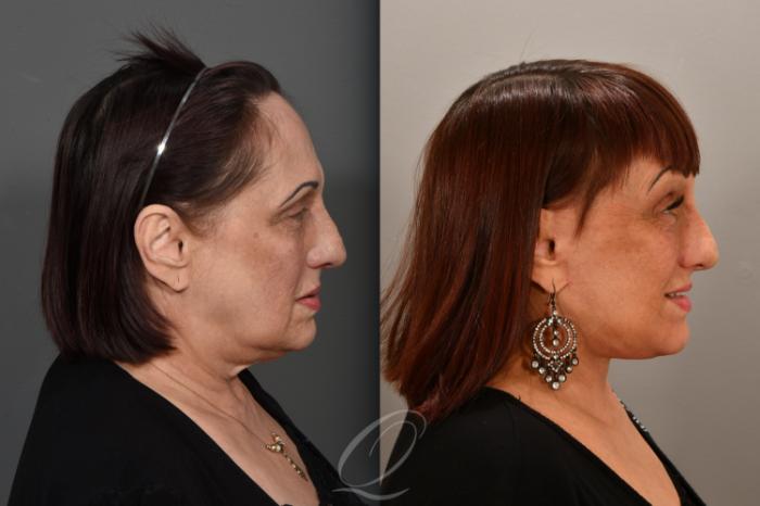 Brow Lift Case 1001707 Before & After Right Side | Serving Rochester, Syracuse & Buffalo, NY | Quatela Center for Plastic Surgery