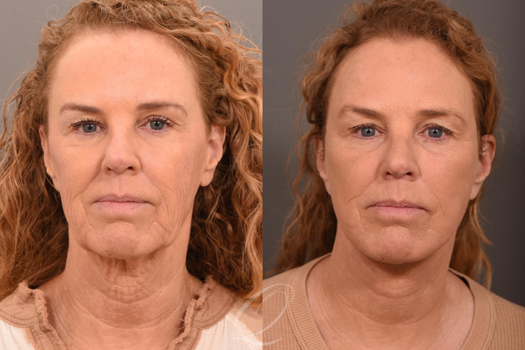 Facelift Case 1001708 Before & After Front | Serving Rochester, Syracuse & Buffalo, NY | Quatela Center for Plastic Surgery
