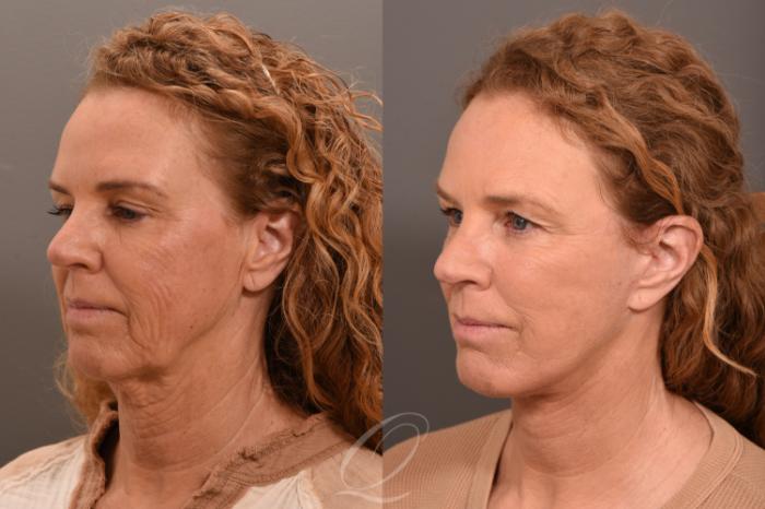 Facelift Case 1001708 Before & After Left Oblique | Serving Rochester, Syracuse & Buffalo, NY | Quatela Center for Plastic Surgery
