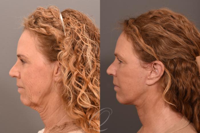 Facelift Case 1001708 Before & After Left Side | Serving Rochester, Syracuse & Buffalo, NY | Quatela Center for Plastic Surgery
