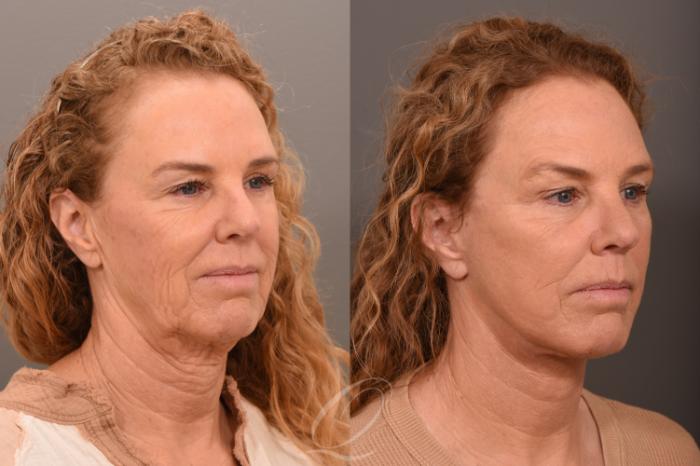 Facelift Case 1001708 Before & After Right Oblique | Serving Rochester, Syracuse & Buffalo, NY | Quatela Center for Plastic Surgery