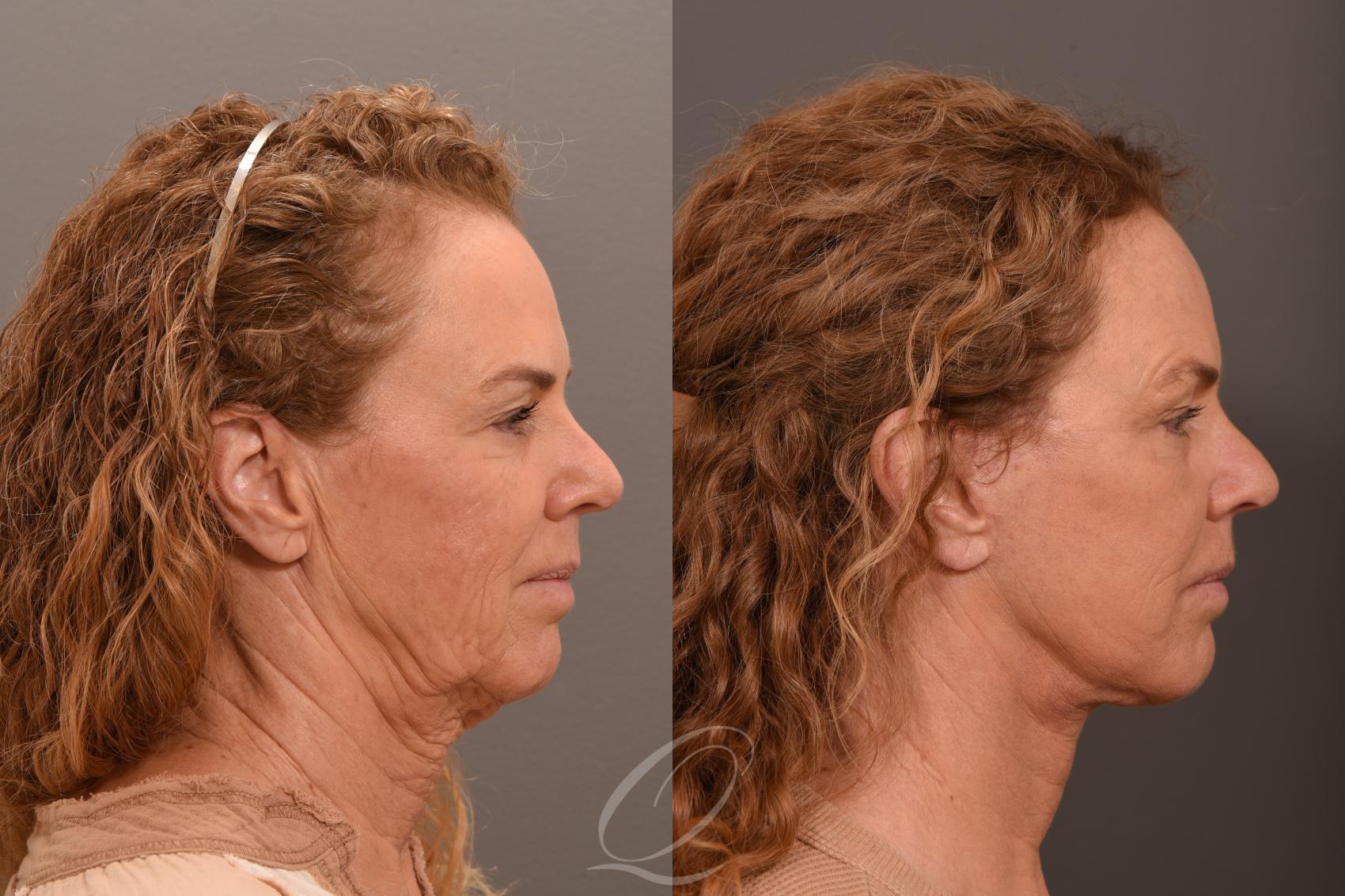 Fat Injections Case 1001708 Before & After Right Side | Serving Rochester, Syracuse & Buffalo, NY | Quatela Center for Plastic Surgery