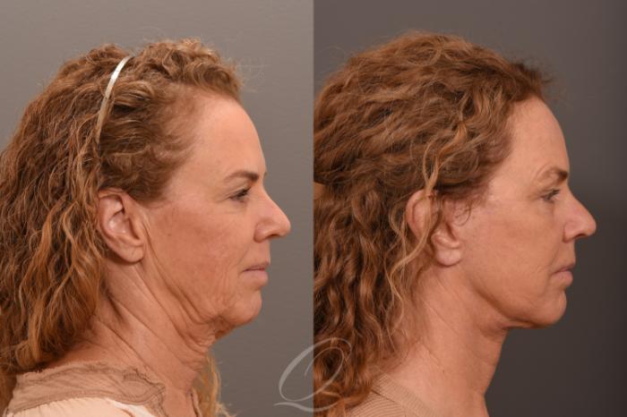 Fat Injections Case 1001708 Before & After Right Side | Serving Rochester, Syracuse & Buffalo, NY | Quatela Center for Plastic Surgery