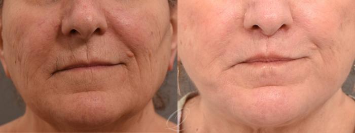 Facelift Case 1001709 Before & After Close Up | Serving Rochester, Syracuse & Buffalo, NY | Quatela Center for Plastic Surgery