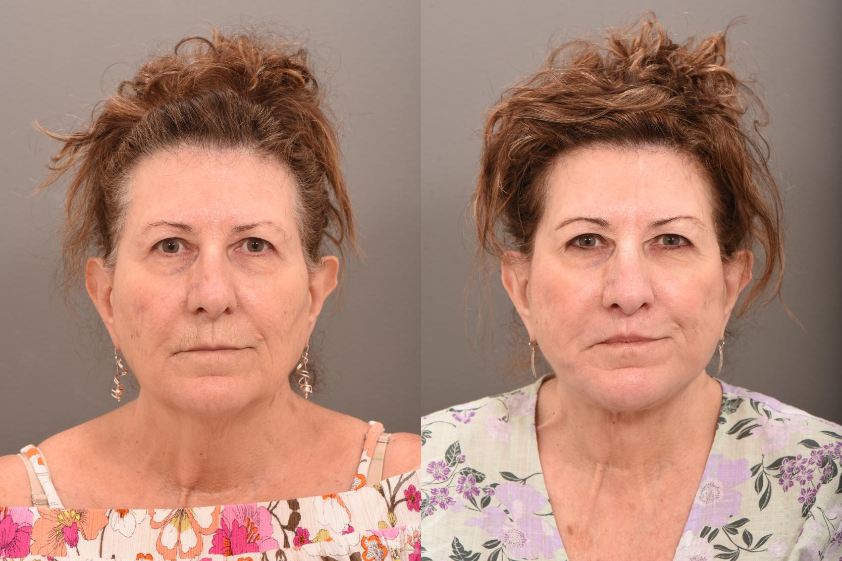 Lip Lift Case 1001709 Before & After Front | Serving Rochester, Syracuse & Buffalo, NY | Quatela Center for Plastic Surgery