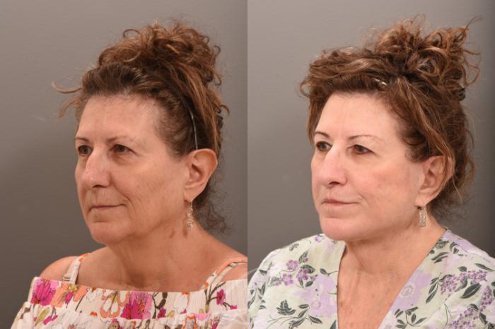 Facelift Case 1001709 Before & After Left Oblique | Serving Rochester, Syracuse & Buffalo, NY | Quatela Center for Plastic Surgery