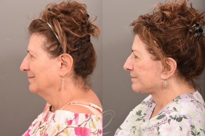 Skin Resurfacing Case 1001709 Before & After Left Side | Serving Rochester, Syracuse & Buffalo, NY | Quatela Center for Plastic Surgery