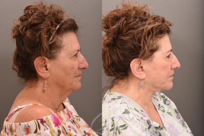 Facelift Case 1001709 Before & After Right Side | Serving Rochester, Syracuse & Buffalo, NY | Quatela Center for Plastic Surgery