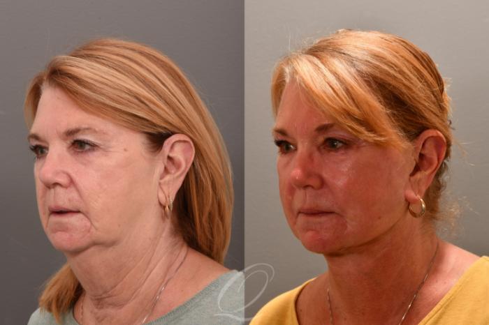 Skin Resurfacing Case 1001732 Before & After Left Oblique | Serving Rochester, Syracuse & Buffalo, NY | Quatela Center for Plastic Surgery