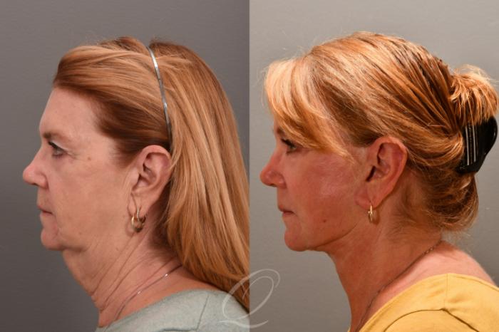 Facelift Case 1001732 Before & After Left Side | Serving Rochester, Syracuse & Buffalo, NY | Quatela Center for Plastic Surgery