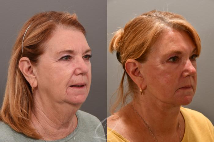 Facelift Case 1001732 Before & After Right Oblique | Serving Rochester, Syracuse & Buffalo, NY | Quatela Center for Plastic Surgery