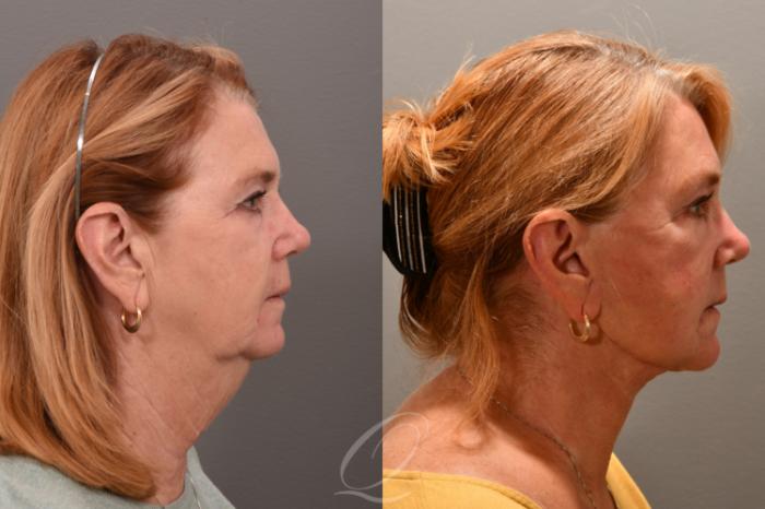 Facelift Case 1001732 Before & After Right Side | Serving Rochester, Syracuse & Buffalo, NY | Quatela Center for Plastic Surgery