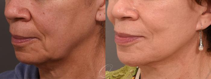 Facelift Case 1001733 Before & After Left Oblique | Serving Rochester, Syracuse & Buffalo, NY | Quatela Center for Plastic Surgery