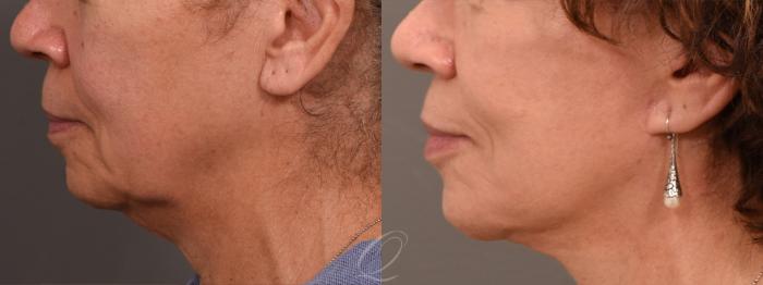 Facelift Case 1001733 Before & After Left Side | Serving Rochester, Syracuse & Buffalo, NY | Quatela Center for Plastic Surgery