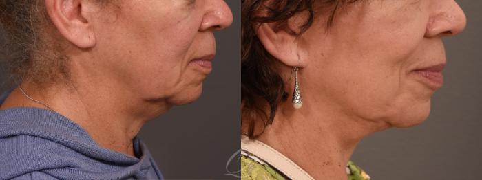 Facelift Case 1001733 Before & After Right Side | Serving Rochester, Syracuse & Buffalo, NY | Quatela Center for Plastic Surgery