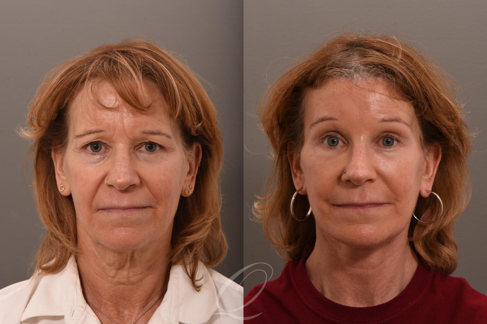 Eyelid Lift Case 1001749 Before & After Front | Serving Rochester, Syracuse & Buffalo, NY | Quatela Center for Plastic Surgery