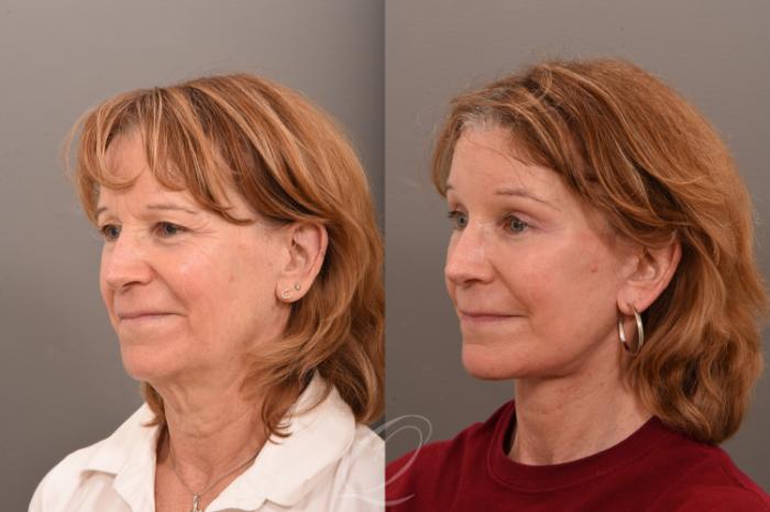 Facelift Case 1001749 Before & After Left Oblique | Serving Rochester, Syracuse & Buffalo, NY | Quatela Center for Plastic Surgery